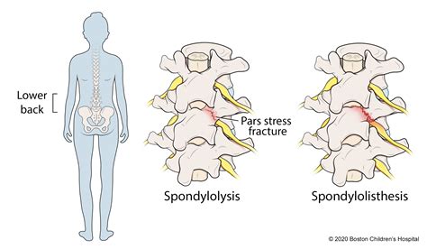 Spondylolysis and Spondylolisthesis | Boston Children's Hospital