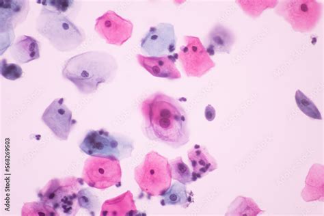 Abnormal squamous epithelial cells view in microscopy.HPV criteria for ...