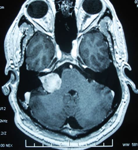 Functional outcome and postoperative complications after the ...