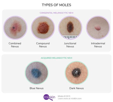 About Moles - Types, Warning Signs, Causes, and Prevention | Skin moles ...