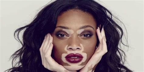 Vitiligo is a skin disease that causes the formation of white spots | Newz