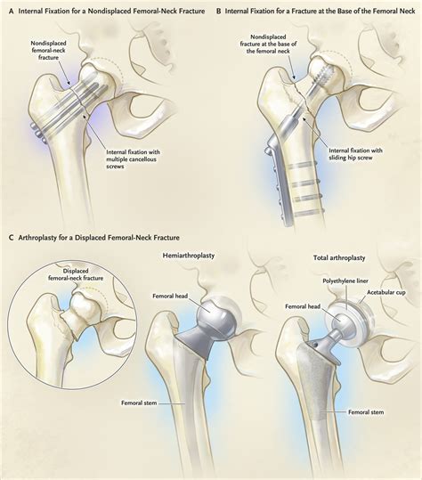 Management of Acute Hip Fracture | NEJM