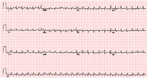 Pe ecg findings - tikloless