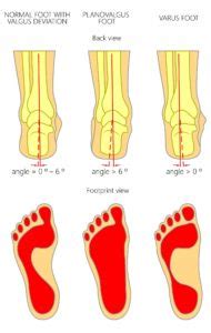 Pronated foot vs supinated foot heel pain - Balance Foot & Ankle ...