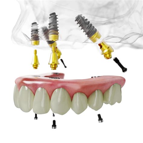 All About the Innovative All-on-4 Dental Implant Procedure