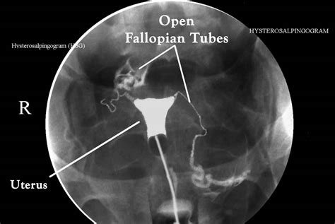 Hysterosalpingogram procedure, uses & hysterosalpingogram side effects