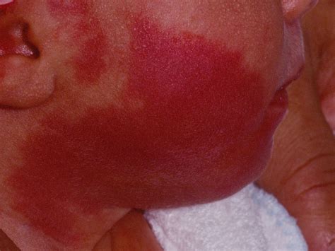 Laser treatment of port wine stains in infancy found safe, effective ...