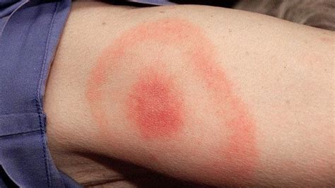 Lyme disease can be diagnosed by 'bull's eye' rash alone - BBC News