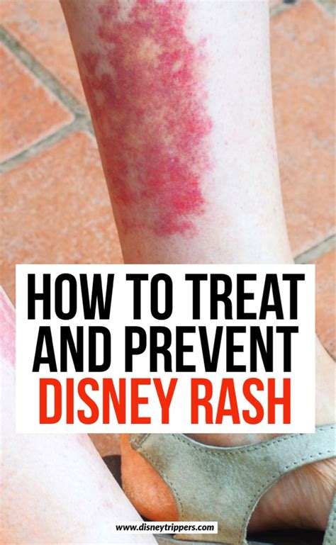 How To Treat And Prevent Disney Rash - Disney Trippers | Disney rash ...