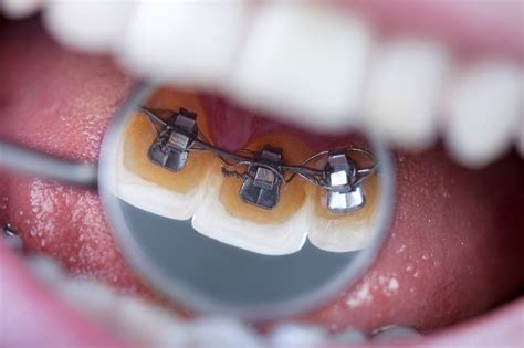 Lingual Braces Brooklyn NY - Halabi Orthodontics