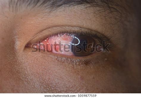 Close Pyogenic Granuloma During Eye Examination Stock Photo 1059877559 ...