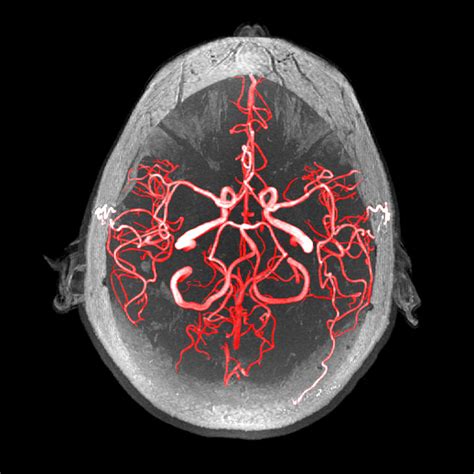 Arteries Of The Brain, Mra Photograph by Evan Oto - Pixels