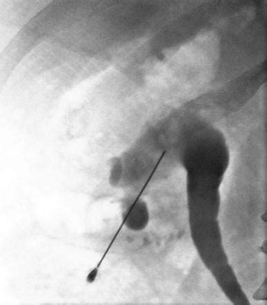 Pyonephrosis, stones and intervention | Image | Radiopaedia.org