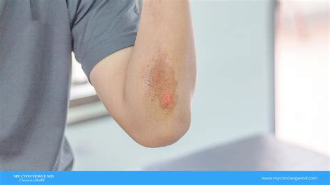 What Are The Difference Between Abrasion VS. Laceration?