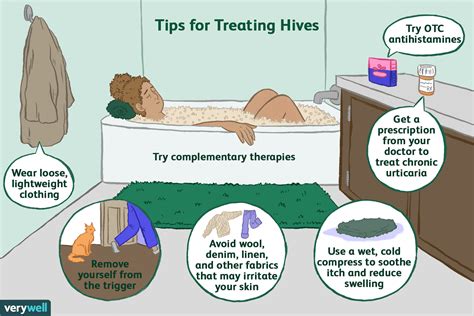 Hives (Urticaria) Treatment