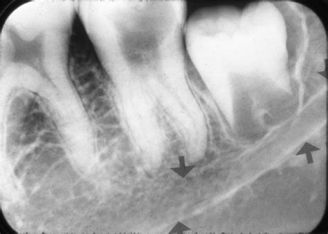 mandibular canal – Dr. G's Toothpix