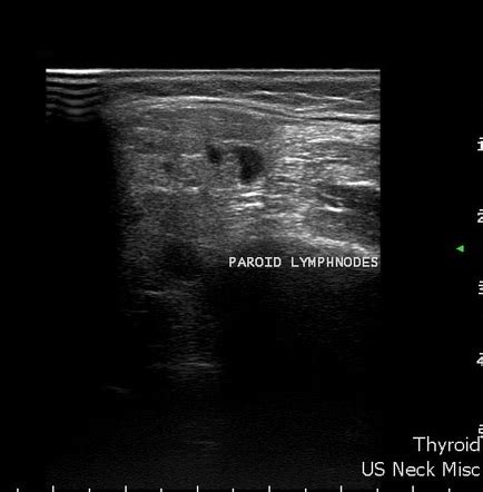 Parotid silolithiasis with parotitis | Radiology Case | Radiopaedia.org