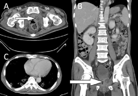 Pelvic Ct Scan