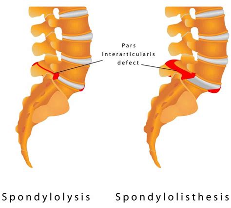 The Difference Between Spondylolysis And Spondylolisthesis?