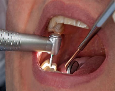 dental-handpiece - Bite Magazine