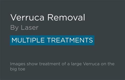 Laser Verruca Removal in Leeds and Bradford - Skin Surgery Clinic