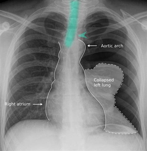 Left Pneumothorax X Ray