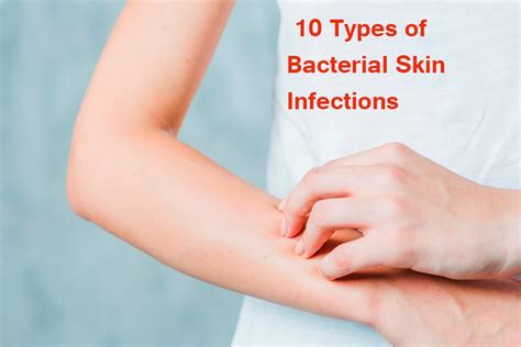 10 Types of Bacterial Skin Infections - Yabibo