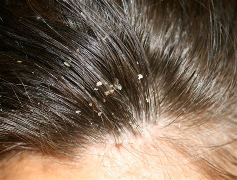 FMS SKIN & HAIR: Best Dandruff Treatment in Hyderabad, India