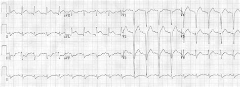 Stemi Ecg Examples