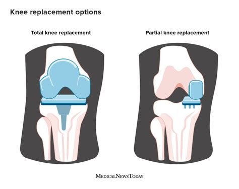 Types of knee replacement