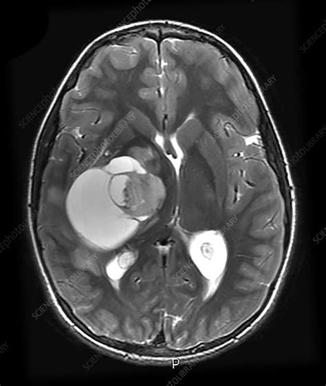 MRI Pilocytic Astrocytoma - Stock Image - C043/3097 - Science Photo Library