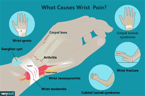 Wrist Pain: Causes, Treatment, and When to See a Healthcare Provider