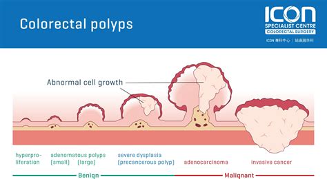 Colorectal polyps — Icon Specialist Centre