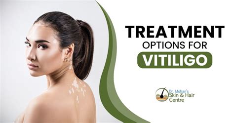 Vitiligo Treatment