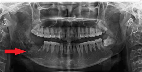 mandibular_angle_fracture_wisdom_tooth - TeethRemoval.com