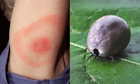 Woman catches Lyme disease from tick bite at Clissold Park, say ...