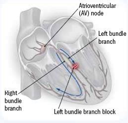 How serious is bundle branch block? - Harvard Health