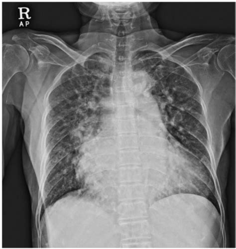 Pulmonary Congestion Chest X Ray