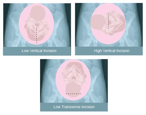 VBAC Vaginal Birth After Cesarean | classical transverse, low vertical