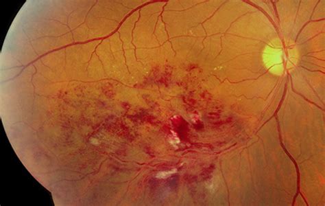 Retinal Vein Occlusions - Retina Specialists of Michigan