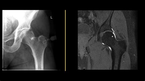 What is an MRI hip arthrogram? - YouTube