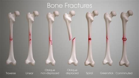 Guide to bone fractures | Bone fracture, Fractures, Fracture symptoms