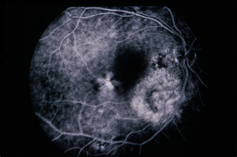 Choroidal Hemangioma / CNVM - Retina Image Bank