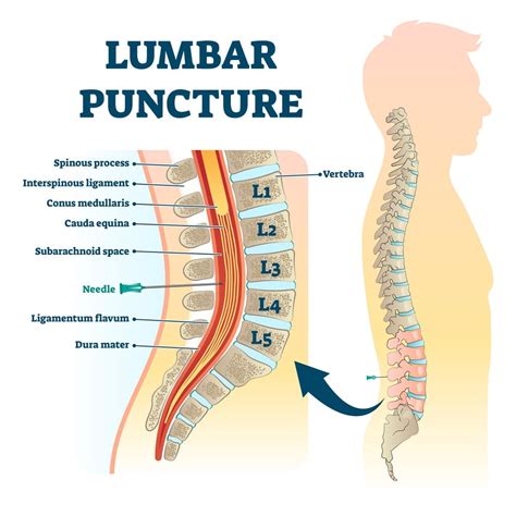 Lumbar Puncture (spinal Tap) Mayo Clinic, 52% OFF