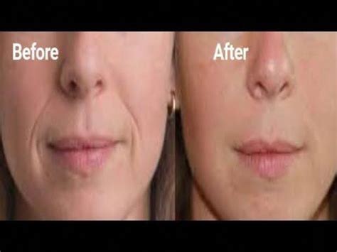 RAPIDLY REMOVE DEEP SMILE LINES FAST LOOK YOUNGER AND WITH THIS WRINKLE ...