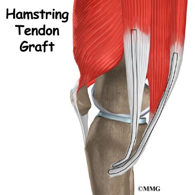 Hamstring Tendon Graft Reconstruction of the ACL - James Seeds, MD ...