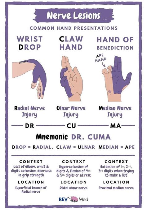 Ape Hand Median Nerve Palsy