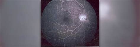 Fluorescein angiography - definition | Eye Disorders and Diseases ...