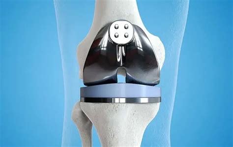 Knee Replacement Surgery - malioon