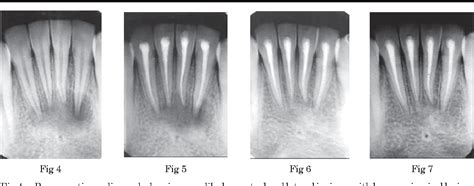 Acute Apical Abscess Radiograph